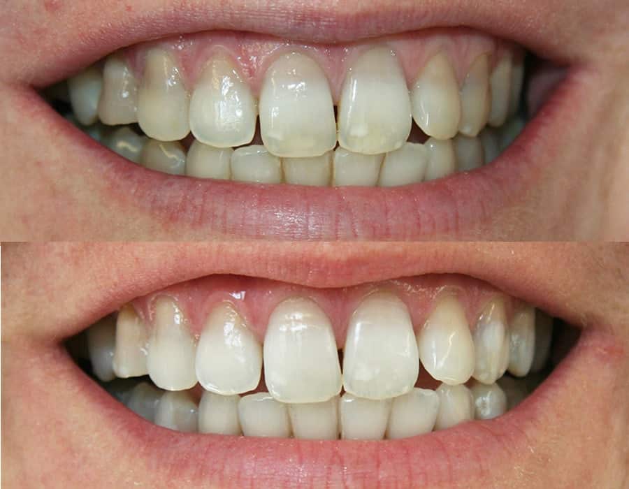 Лазерное отбеливание отзывы. Отбеливание зубов. Зубы до и после фотоотбеливания. Отбеливание зубов до и после. Зубы до и после отбеливания.