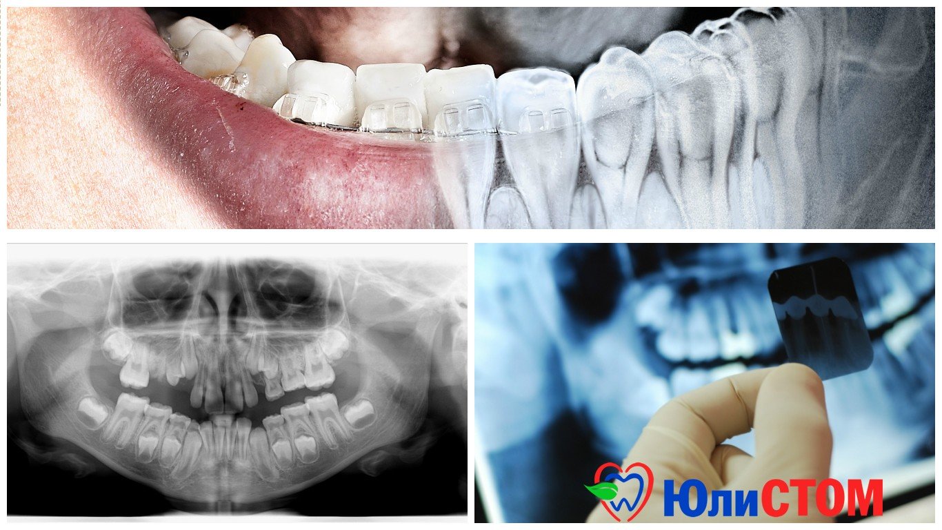Рентгеновские снимки зубов