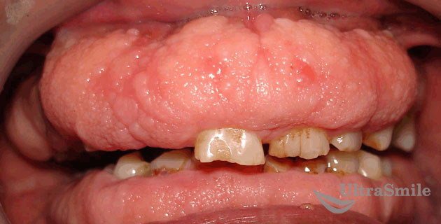 Гиперплазия или разрастание десны во рту – как лечить?