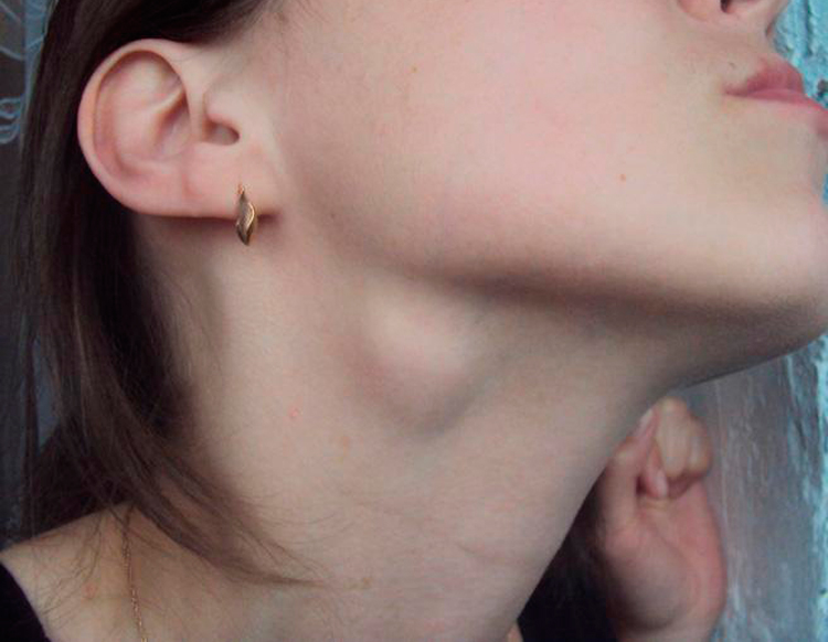 10 патологий, из-за которых появляется шишка под челюстью