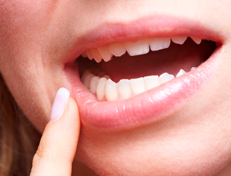 7 типов стоматита, которые приводят к белым язвам во рту