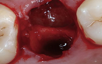 кровяной сгусток после удаления зуба фото