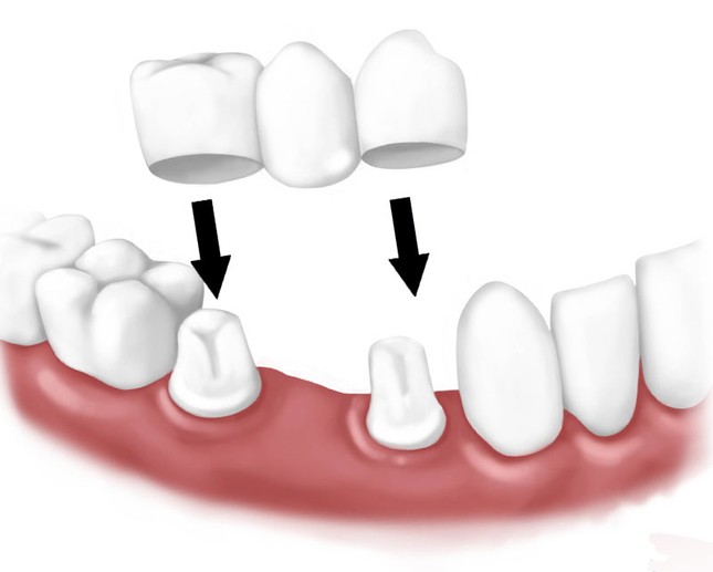 Принцип устройства зубного моста