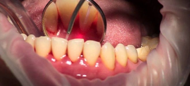 как удаляют кисту зуба