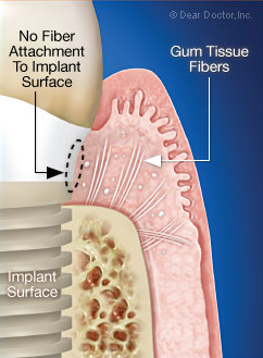 No fiber attachment to the implant surface