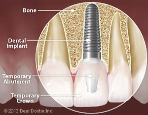 Same-day tooth replacement with dental implants.
