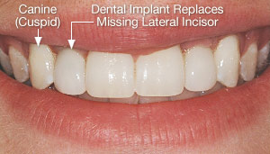 Dental implant replaced congenitally missing lateral incisor.