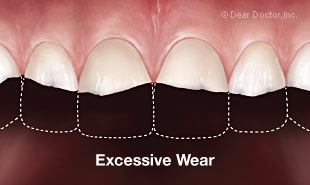 Excessive tooth wear