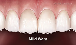 Mild tooth wear