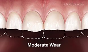 Moderate tooth wear