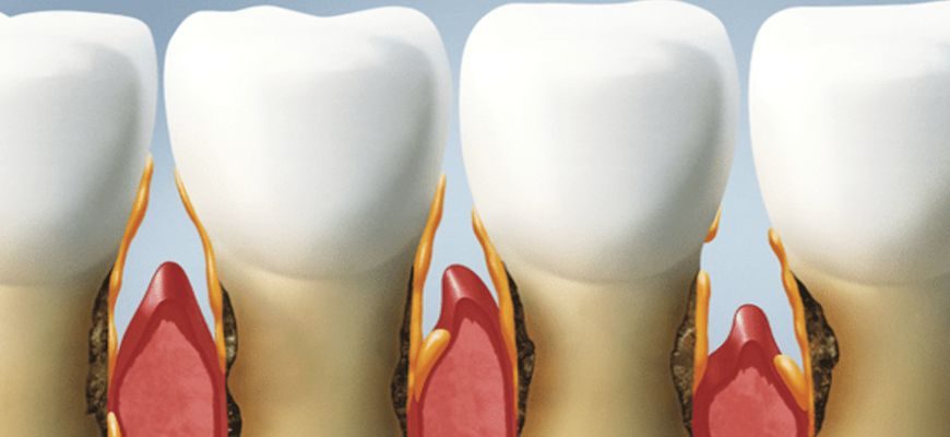 periodontit-zuba-chto-eto-takoe-kak-lechit-v-domashnih-39rn7ziseh6ejuevgmmm80.jpg