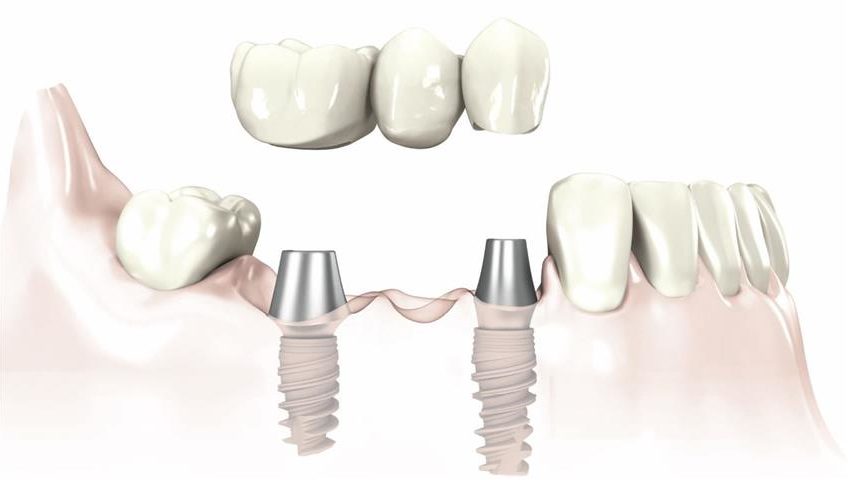 Implants-and-bridge-2-848x480.jpg