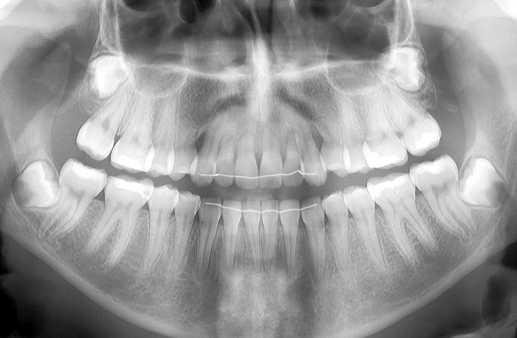 Снимок. Ортопантомограмма челюсти. Сверхкомплектные зубы рентген. ОПТГ зубных рядов Пикассо.