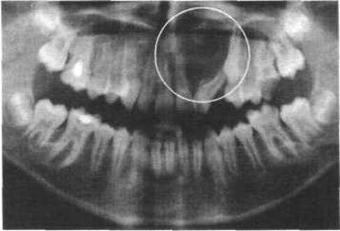Киста зуба на рентгенограмме