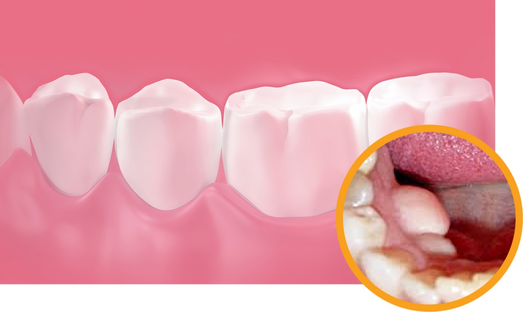 Экзостоз зуба или челюсти - причины, лечение, показания к операции