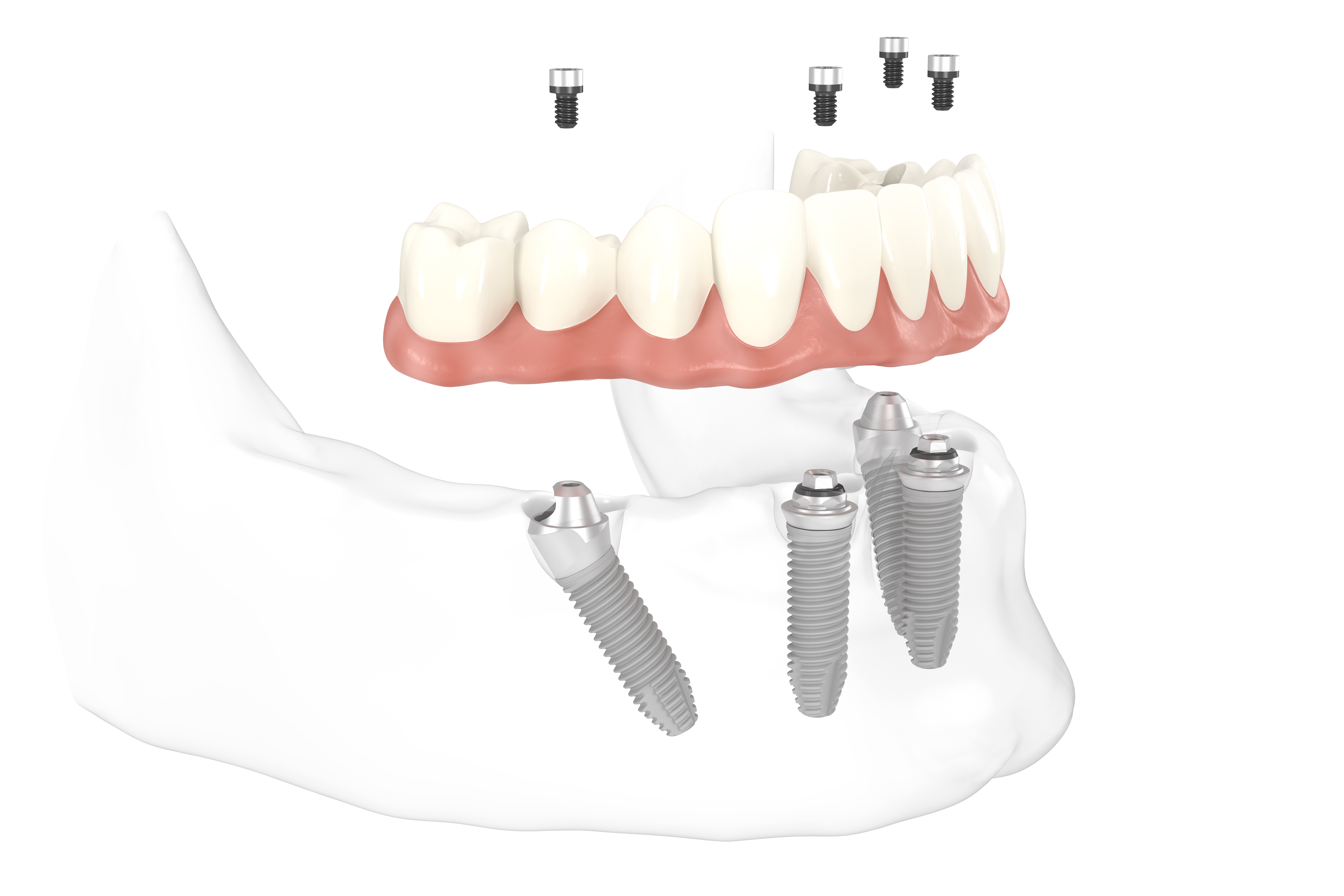 Протезирование зубов в казани. Имплантация по системе all-on-4 (Nobel, США). Имплантологическая кассета Nobel полный набор для all on 4.