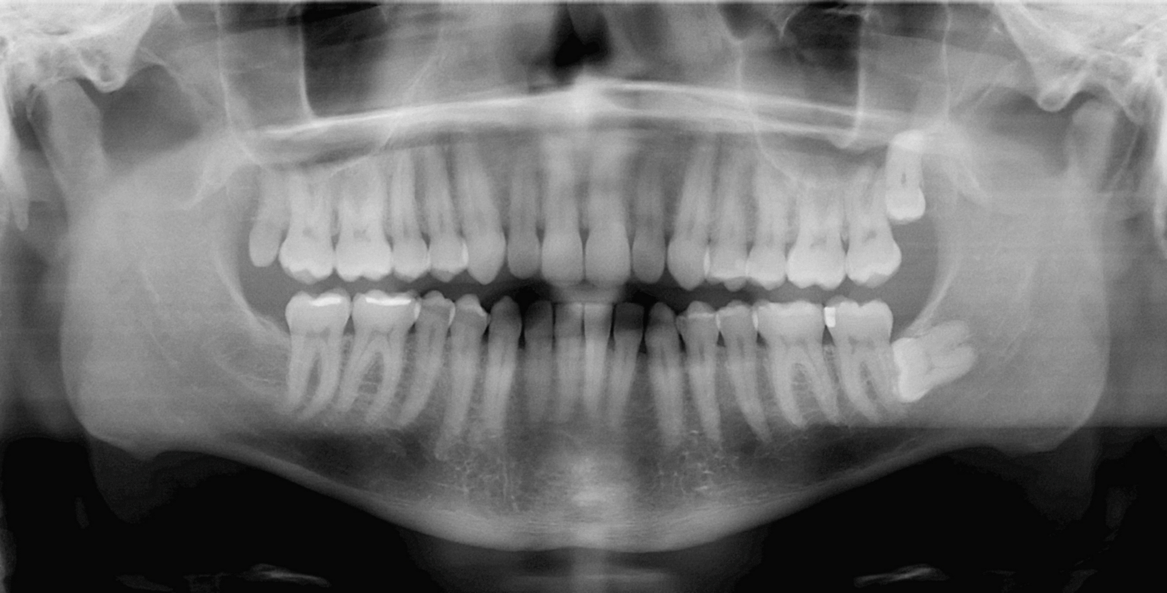 Углы для рентгенографии зубов