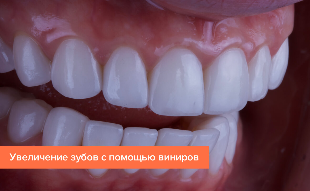 Фото зубов увеличенных с помощью виниров