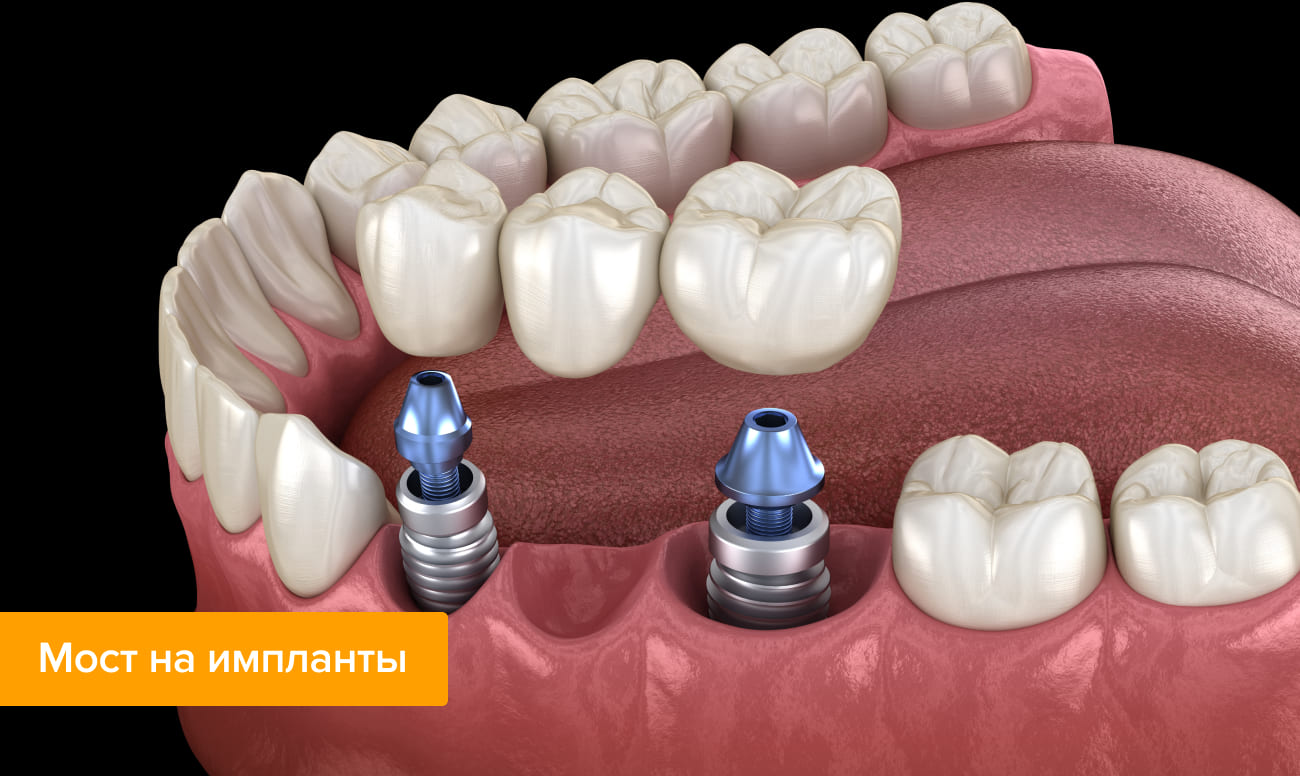 Установка Моста Зубы Стоимость