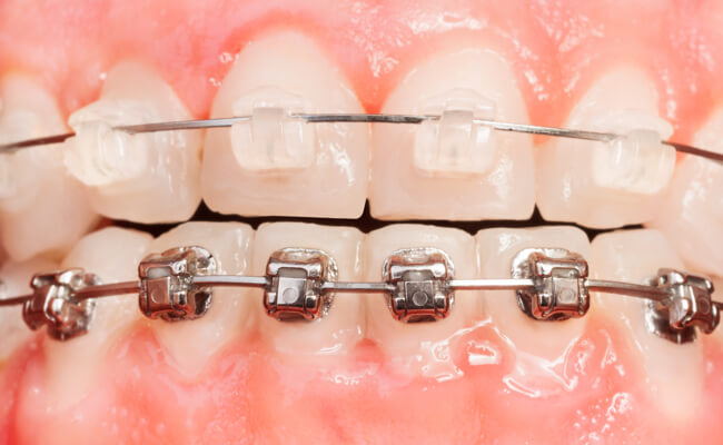 Фото комбинированных брекетов на зубах