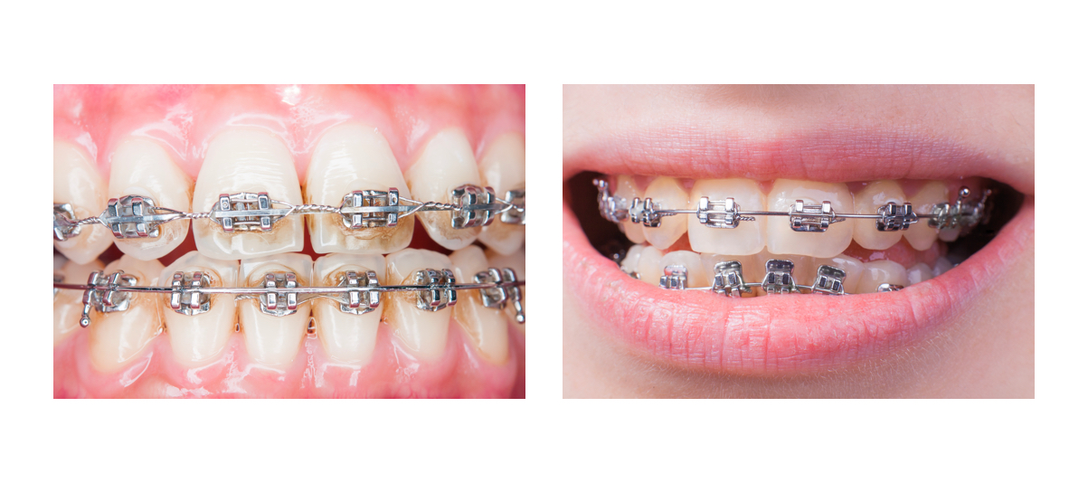 Фото лигатурной и самолигирующей брекет–систем на зубах