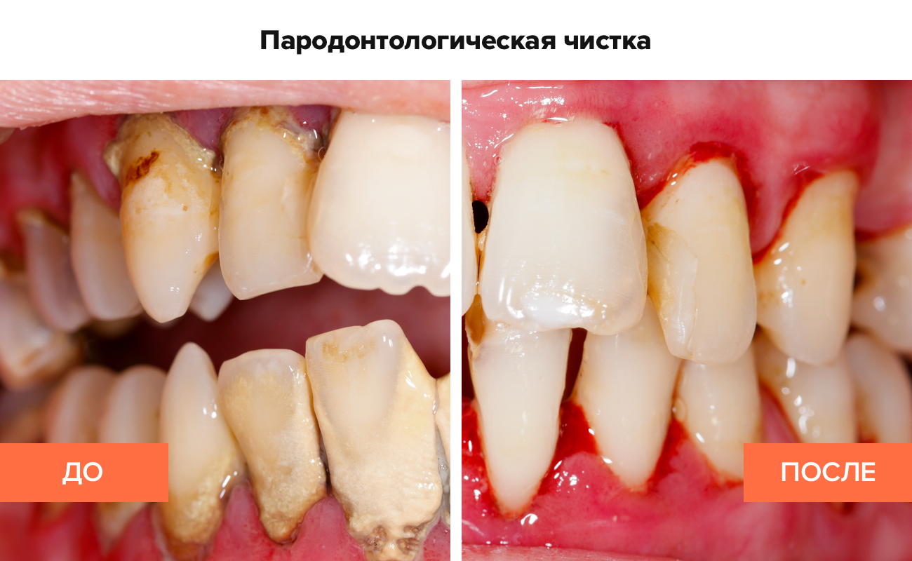 Фото до и после пародонтологической чистки