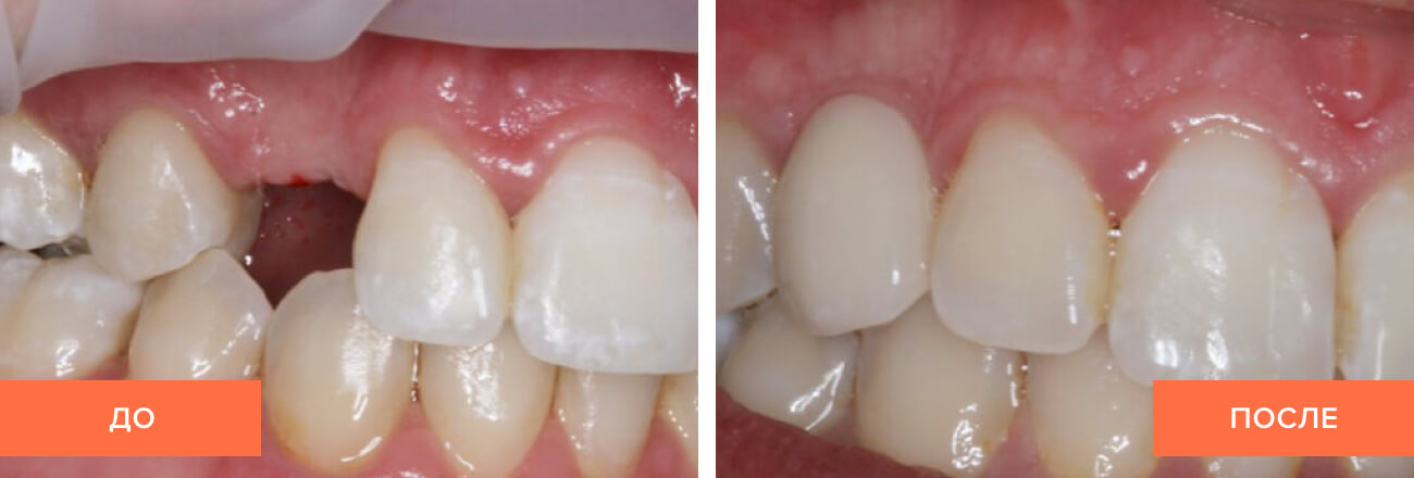 Фото до и после установки импланта пациенту