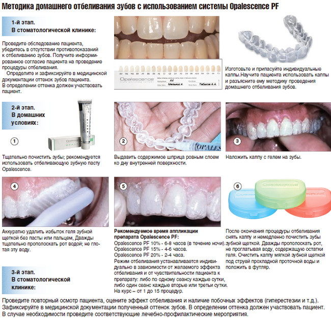 Отбеливание зубов инструкция. Отбеливание Opalescence этапы. Внутрикоронковое отбеливание зубов методика. Opalescence отбеливание зубов 15%. Опалесценс 20 домашнее отбеливание.