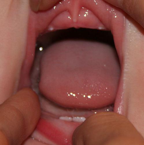 неправильная последовательность прорезывания зубов у детей