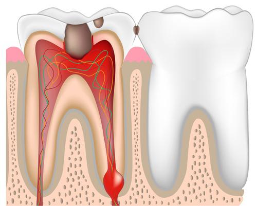 болит зуб после лечения глубокого кариеса