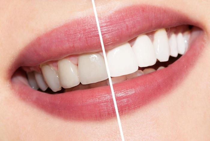 отбеливание зубов маслом чайного дерева отзывы стоматологов