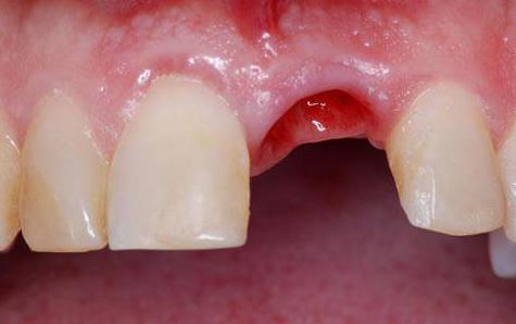 полоскать ли рот после удаления зуба 