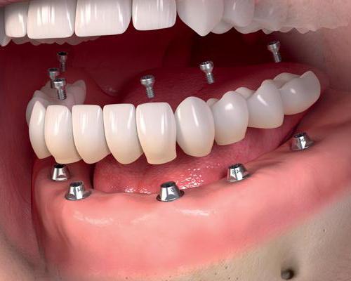 зубной мост или имплант что лучше отзывы 