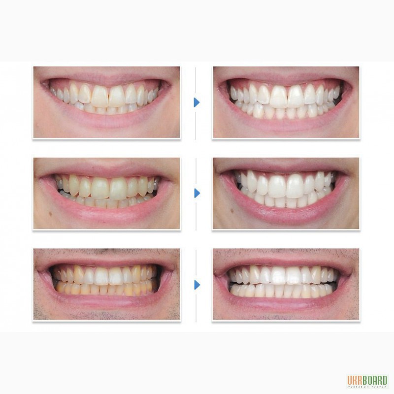 Отбеливание зубов минусы. Отбеливание зубов. Профессиональное отбеливание зубов. Этапы отбеливания зубов в стоматологии.