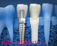 какие зубные импланты выбрать