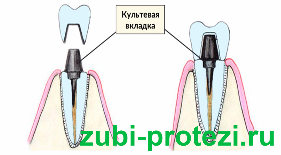 Наращивание зуба на штифт рисунок