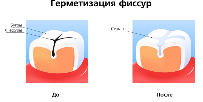 герметизация зуба