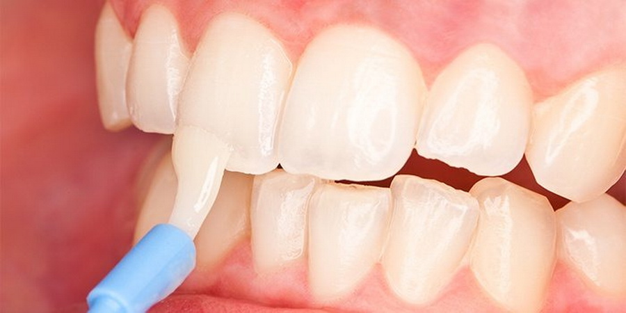 Реминерализация зубов: как проводится процедура, препараты, отзывы