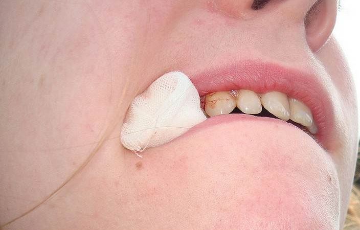 Таблетки после удаления зуба