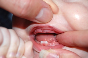 Проблемы со здоровьем при прорезывании зубов