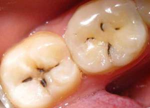 Что такое пульпит зуба и как он выглядит.