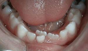Все ли молочные зубы меняются на коренные — Зубы