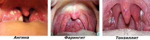 Воспалительные заболевания горла