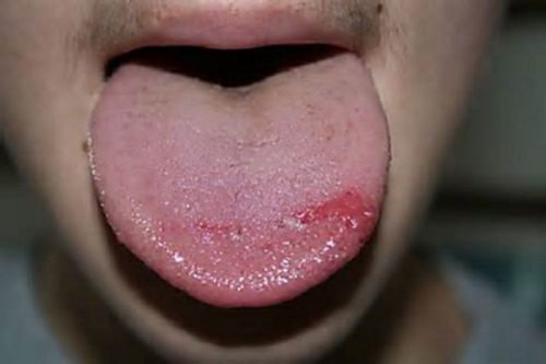 Травма языка