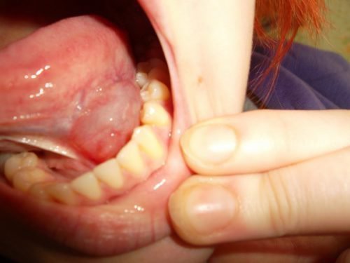 Воспаление слюнной железы во рту