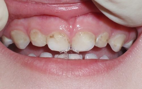 Начальный кариес на молочных зубах можно вылечить 