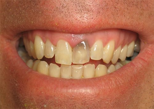 Потемнение зуба после лечения