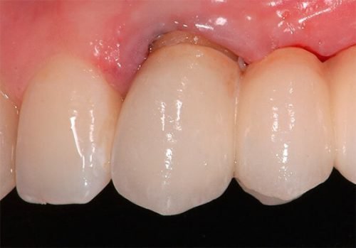 Кариес корня зуба - диагностика