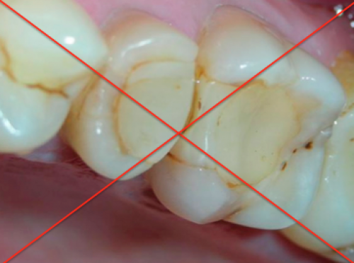 Некачественные пломбы в зубе