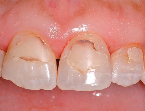 Вторичный кариес на передних зубах